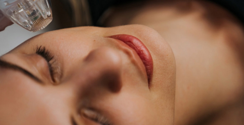 Visage Microneedling RF