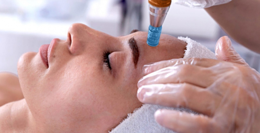 Microneedling-Behandlung